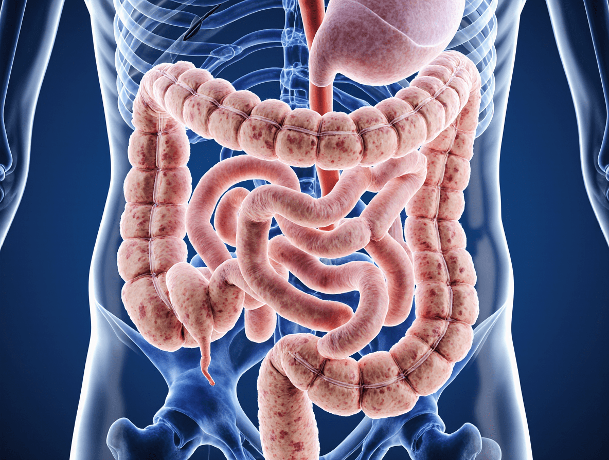 Синдром дырявого кишечника Синдром дырявого кишечника